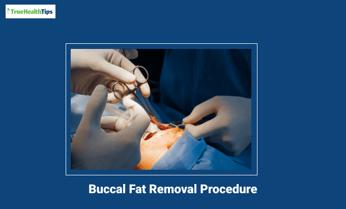 Buccal Fat Removal Procedure