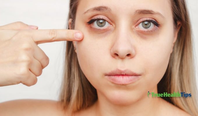 what causes dark circles under eyes