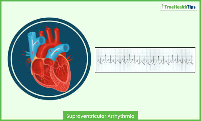 Supraventricular Arrhythmia