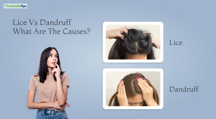 Lice Vs Dandruff What Are The Causes