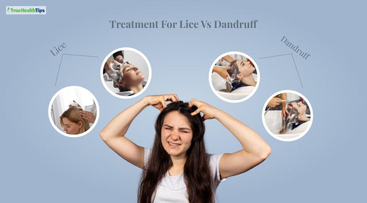 Treatment For Lice Vs Dandruff
