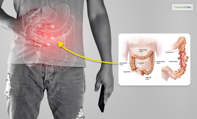 Diverticulitis