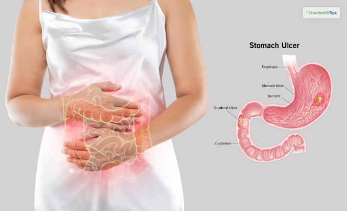 Stomach Ulcers