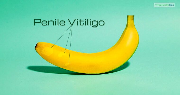 Penile Vitiligo