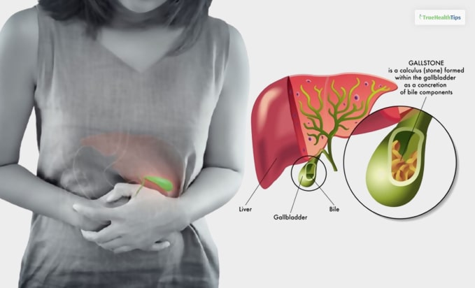 Can You Get Gallstones Without A Gallbladder