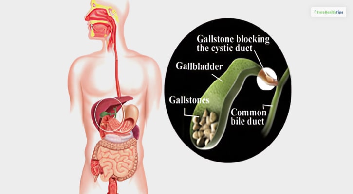 Can You Get Gallstones Without A Gallbladder?