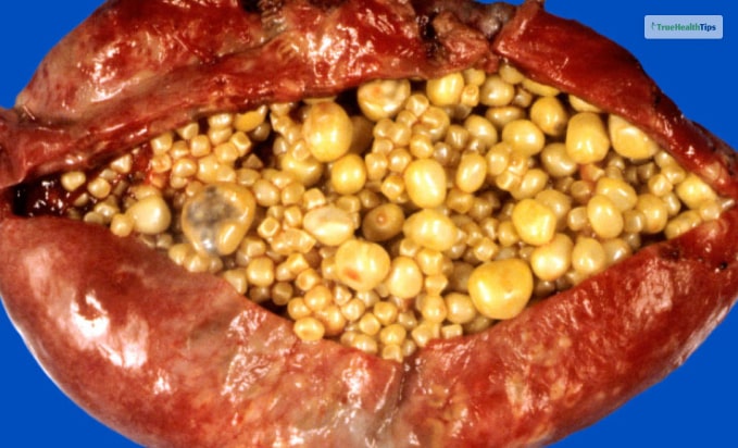 Cholesterol Gallstones