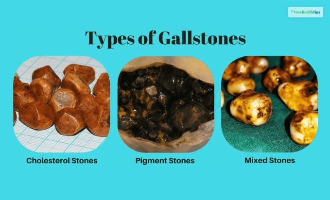 Types Of Gallstones