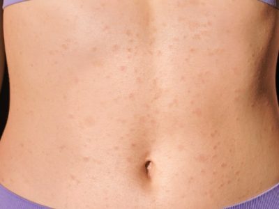 What Is Covid Rash Definition, Symptoms, Identification, And Types