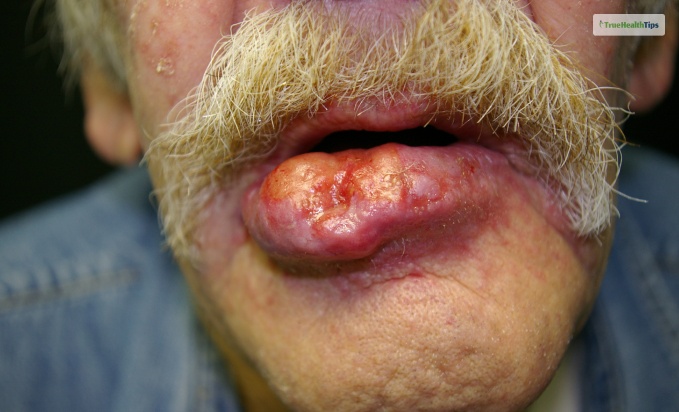 Symptoms of lip cancer