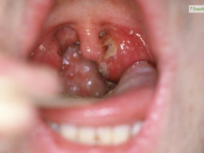 How Long Does Strep Throat Last Find The Answer Here!