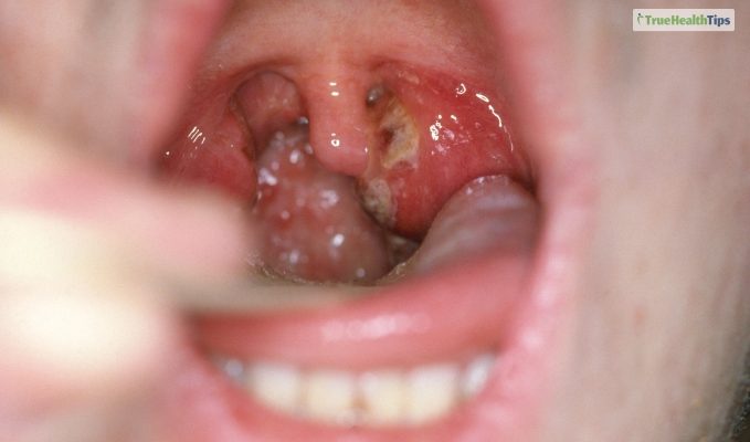 How Long Does Strep Throat Last Find The Answer Here!