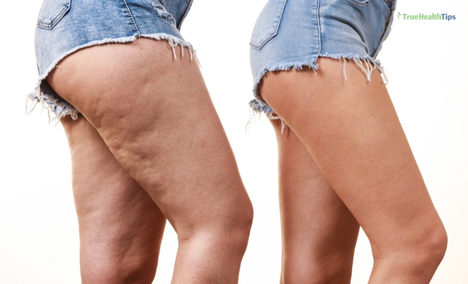 Thighs Coolsculpting Before And After