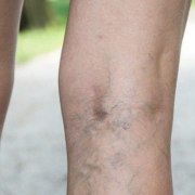 what can worsen varicose veins