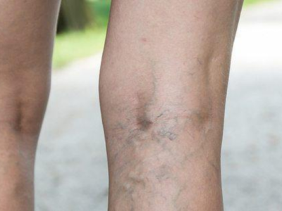 what can worsen varicose veins