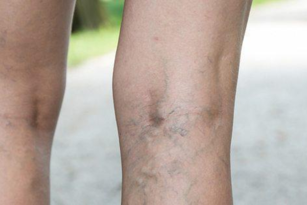 what can worsen varicose veins