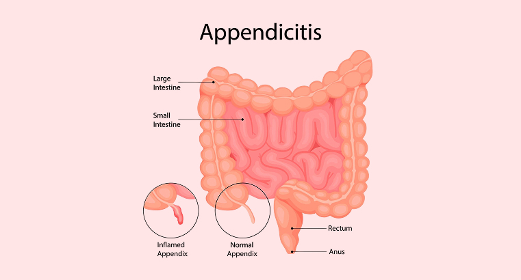 A Brief Guide To Appendicitis