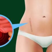 what does appendicitis feel like