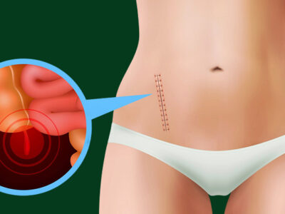 what does appendicitis feel like